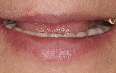 ¿Qué es el edentulismo? Síntomas, causas, prevención y soluciones a la pérdida dental