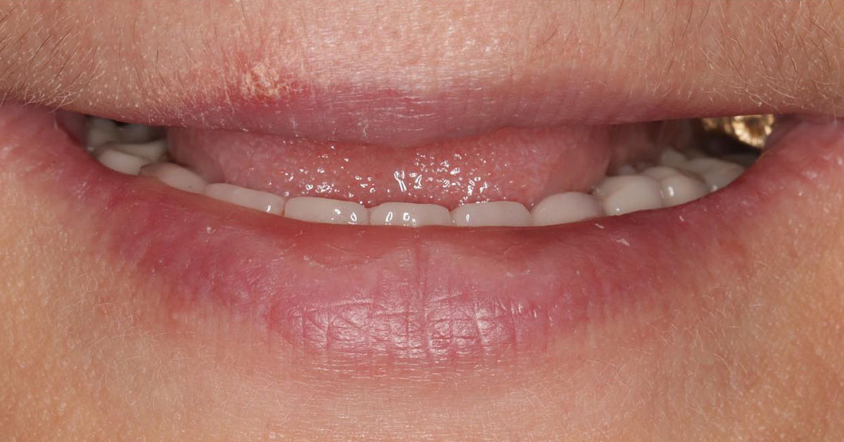 Primer plano de la boca de una persona paciente de edentulismo. Esta imagen se utiliza para ilustrar una entrada sobre qué es el edentulismo y cuáles son sus síntomas y tratamiento.