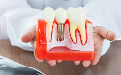 ¿Qué es un implante dental, cómo se pone y cuánto cuesta?