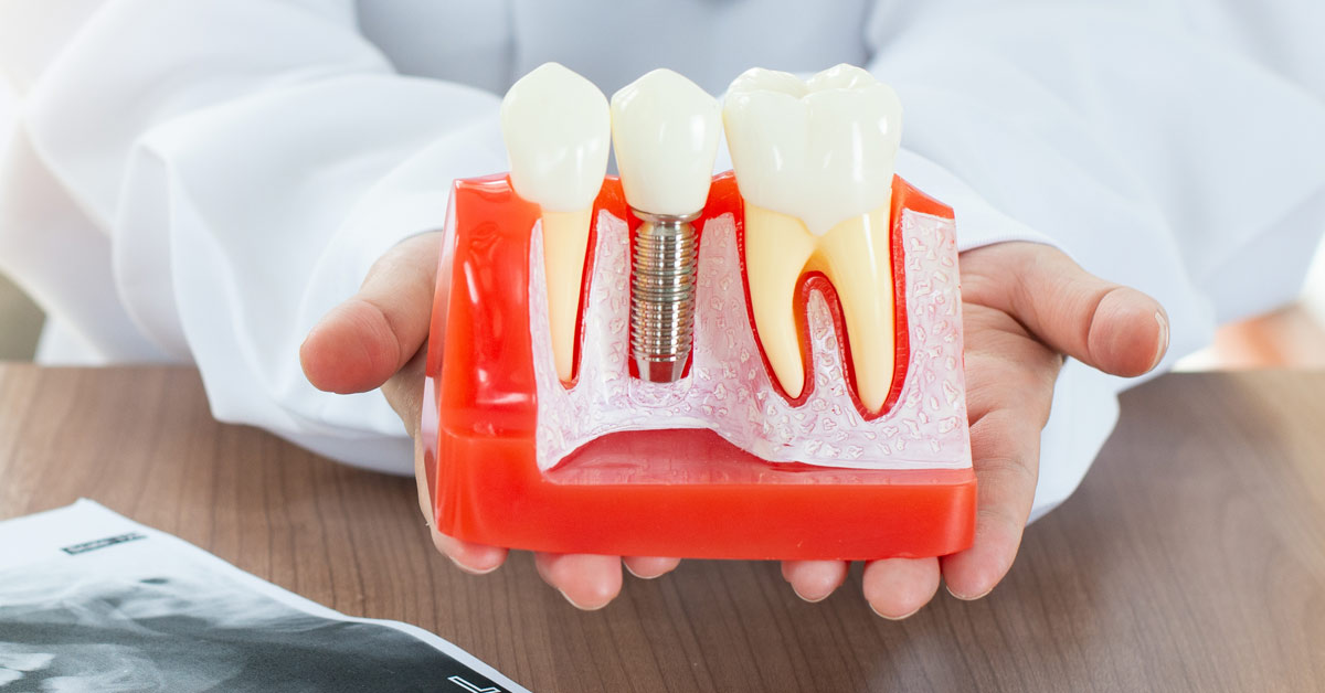 Dentista mostrando un amaqueta con un implante dental.