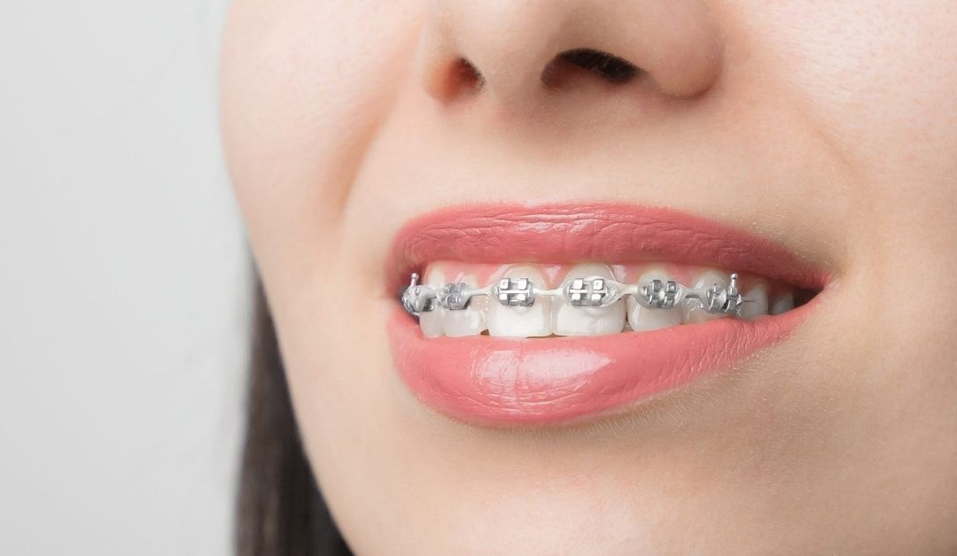 Tipos de ortodoncia: ¿cuáles hay y cómo saber cuál es el mejor para mí?