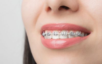 Tipos de ortodoncia: ¿cuáles hay y cómo saber cuál es el mejor para mí?