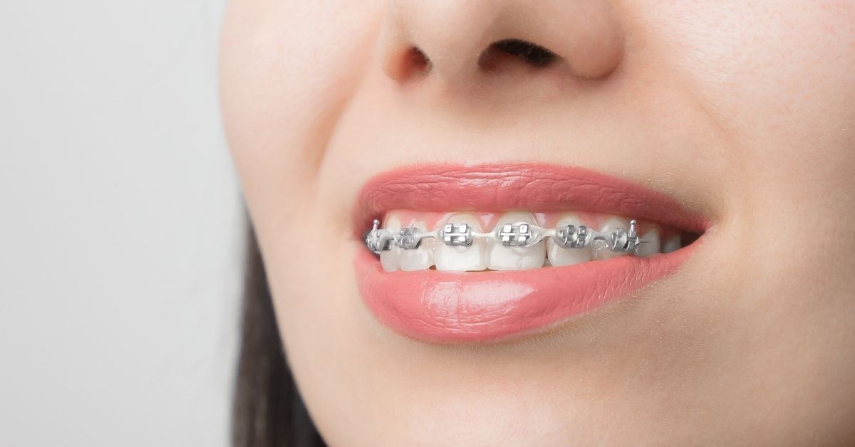 Primer plano de una chica mostrando los brackets. Esta imagen se utiliza para ilustrar una entrada sobre los tipos de ortodoncia.
