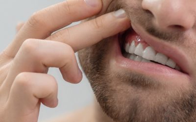 ¿Qué es la periodontitis, cuáles son sus síntomas y sus causas y cómo se trata?