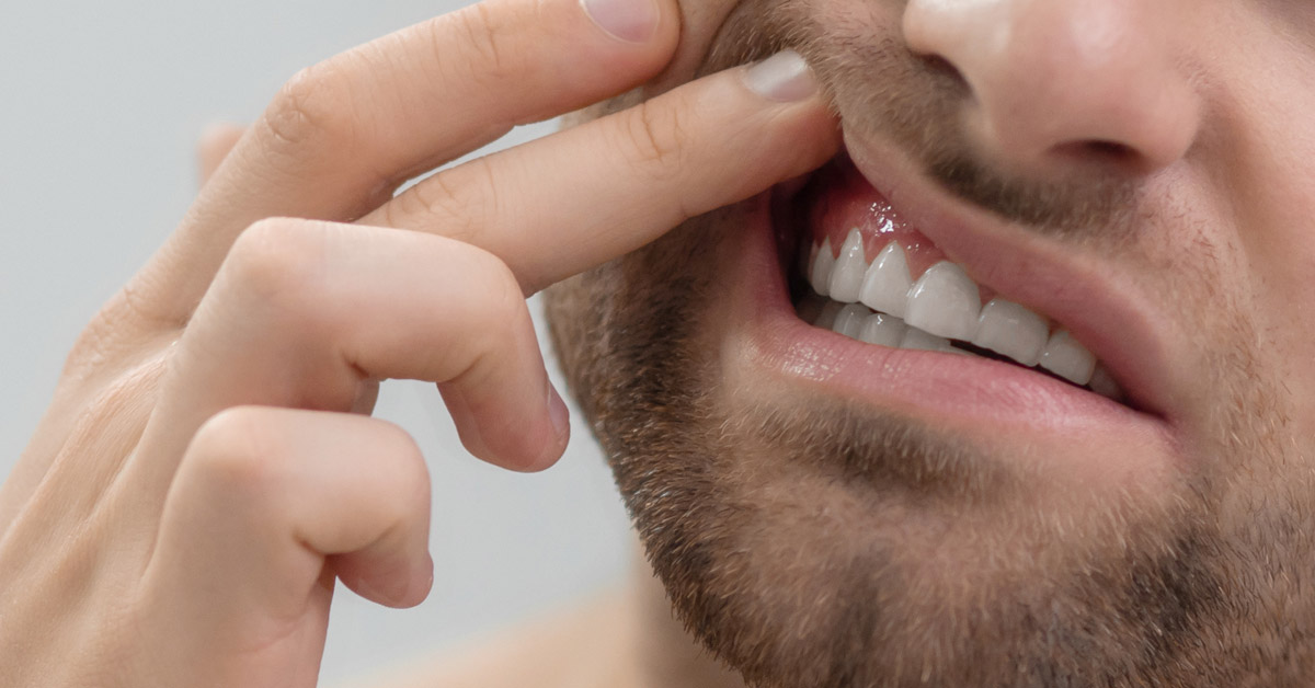 Primer plano de un hombre levantando el labio mostrando la encía superior. Esta imagen se utiliza para ilustrar una entrada sobre qué es la periodontitis.