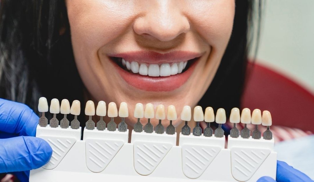 Primer plano de una mujer sonriendo y las manos de un odontólogo sosteniendo una guía de color. Esta imagen se utiliza para ilustrar una entrada sobre qué son las carillas dentales.