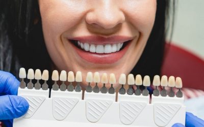 ¿Qué son las carillas dentales, para qué sirven y cómo se ponen?