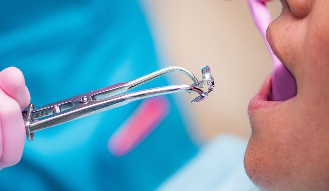 Primero plano de las manos de una dentista sosteniendo material odontológico frente a la boca abierta de un paciente.