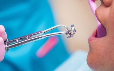 ¿Qué es una endodoncia, cómo se hace y cuándo hay que hacerla?