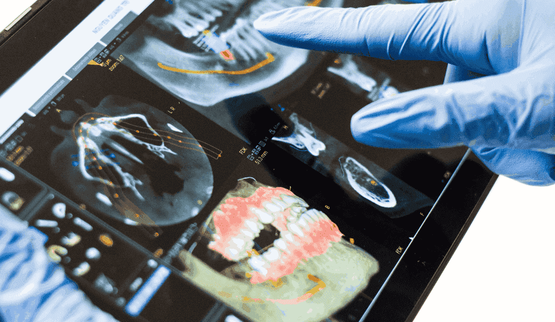 Cirugía guiada por ordenador: Todo lo que tienes que saber sobre esta técnica para la colocación de implantes