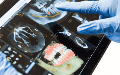 Cirugía guiada por ordenador: Todo lo que tienes que saber sobre esta técnica para la colocación de implantes