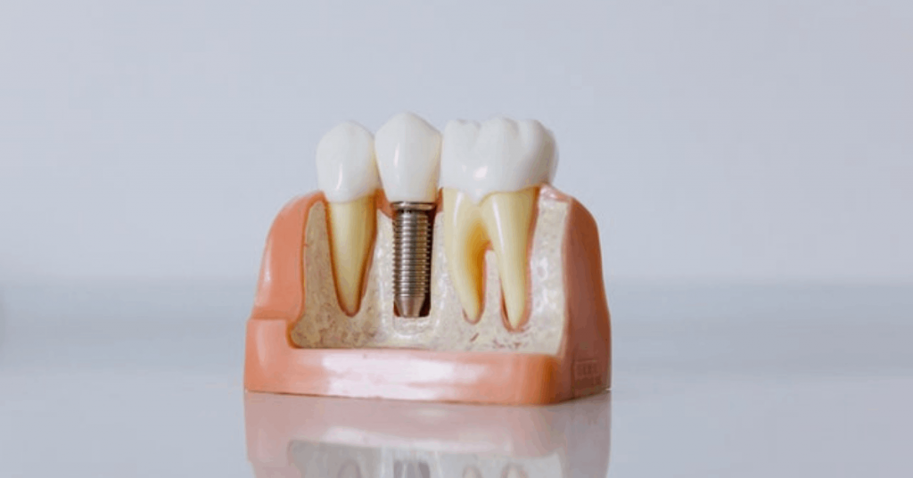 Detalle de un implante dental