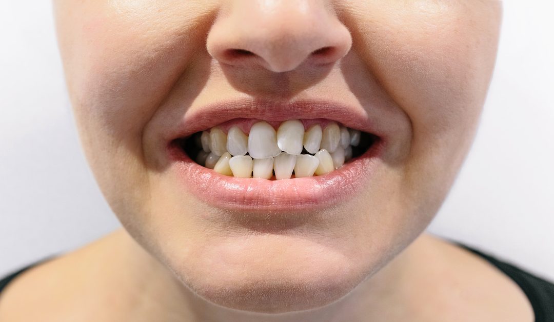 ¿Qué es el apiñamiento dental? Causas, tipos y tratamientos