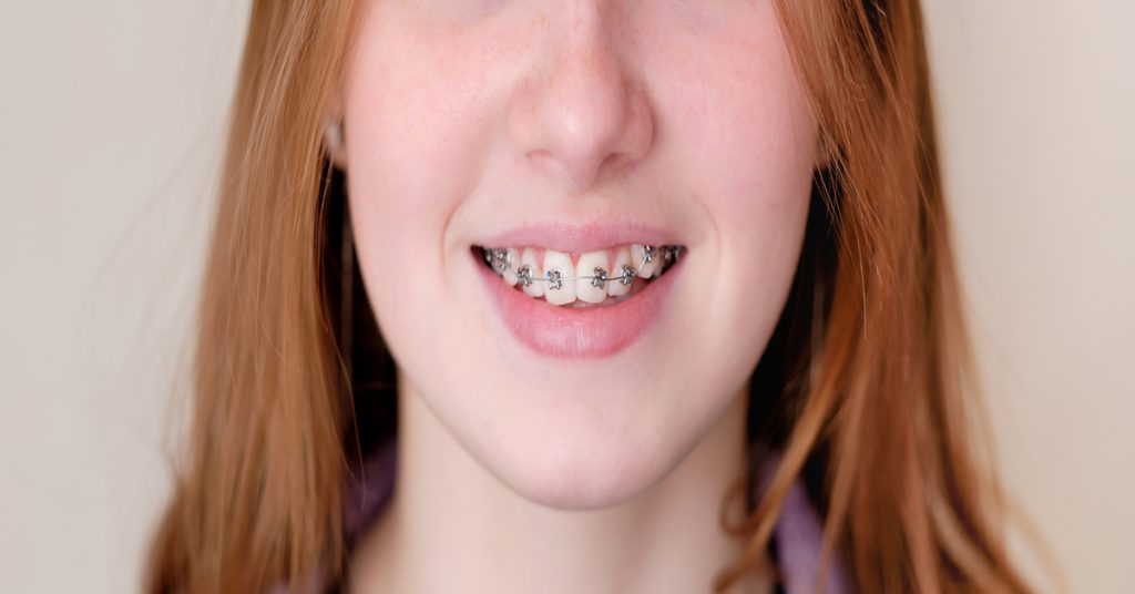 detalle adolescente con ortodoncia para corregir el apiñamiento dental 