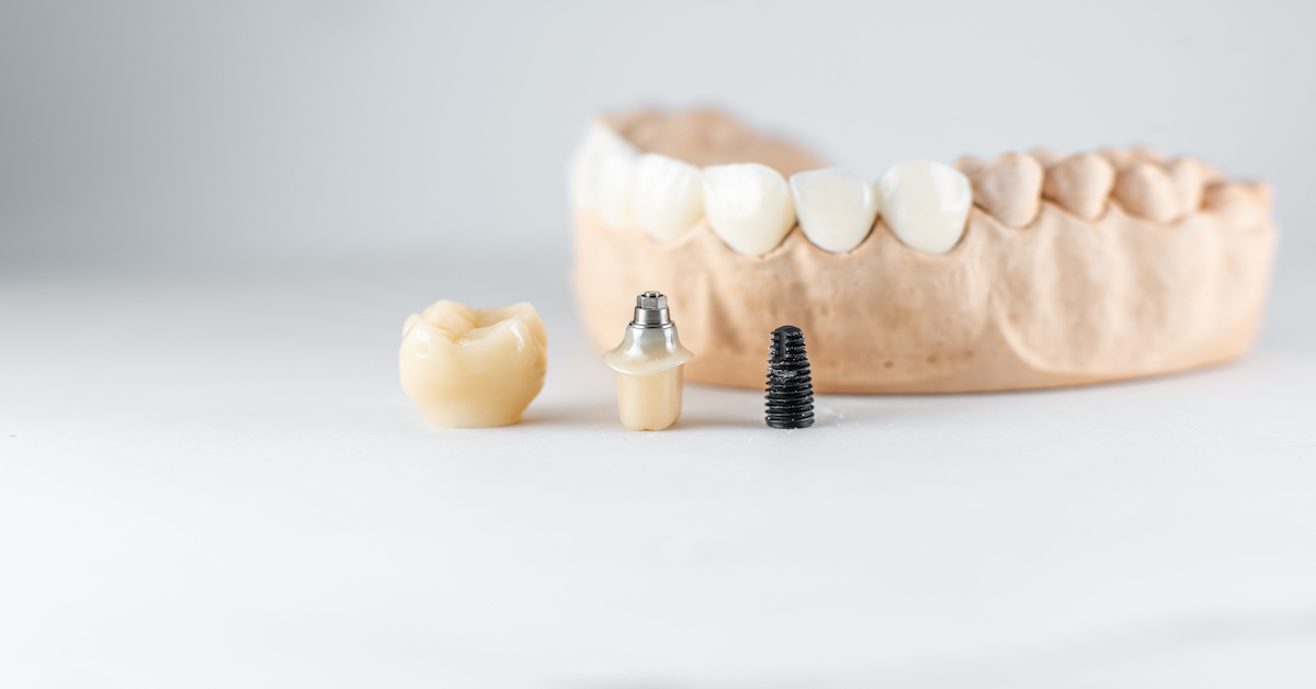 partes que integran un implante dental